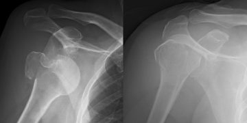 Hombro dislocado, ¿qué ejercicios hacer para recuperarme?