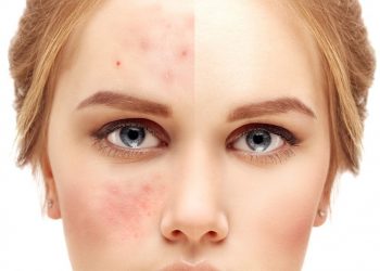 La era del ‘skin positivity’: el movimiento que apoya la aceptación de las imperfecciones de tu piel
