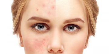 La era del ‘skin positivity’: el movimiento que apoya la aceptación de las imperfecciones de tu piel