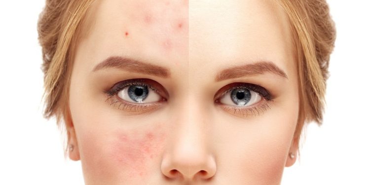 La era del ‘skin positivity’: el movimiento que apoya la aceptación de las imperfecciones de tu piel