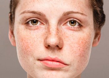 ¿Qué es la parálisis facial?