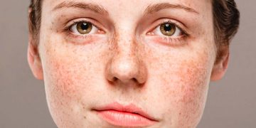 ¿Qué es la parálisis facial?