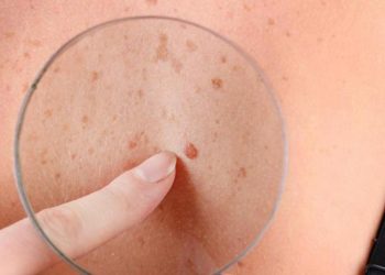 Melanoma: qué es la regla del ABCDE y cómo se detecta a tiempo este cáncer de piel