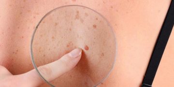 Melanoma: qué es la regla del ABCDE y cómo se detecta a tiempo este cáncer de piel