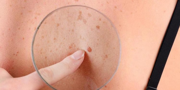 Melanoma: qué es la regla del ABCDE y cómo se detecta a tiempo este cáncer de piel