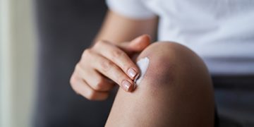¿Por qué me salen con frecuencia moratones en la piel sin golpearme?