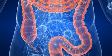 Cáncer de colon: ¿se puede prevenir?