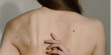 Los lunares en verano: cómo examinarlos y protegerlos del sol
