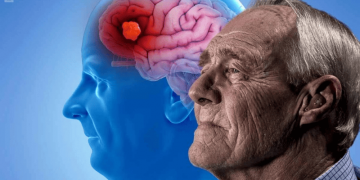 Cómo diferenciar un síndrome con pérdida de memoria del Alzheimer