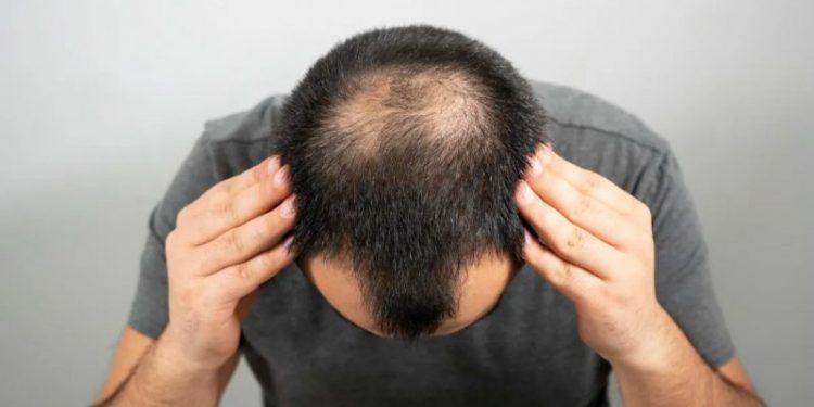 Los tratamientos efectivos y los ineficaces para la calvicie
