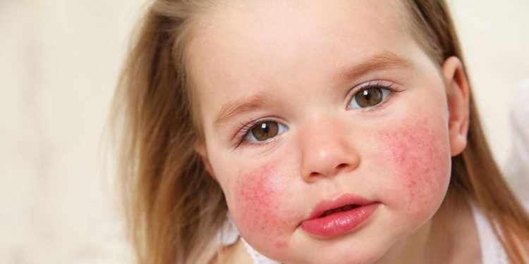 Dermatitis atópica