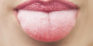 El riesgo de tener la lengua blanca: cómo mantenerlo bajo control