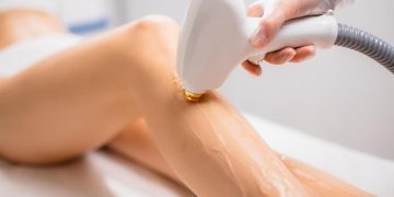 Depilación láser en verano: consejos para protegerte del sol y obtener resultados óptimos