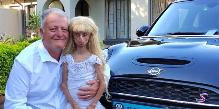 Fallece Beandri Booysen, la joven tiktoker de 19 años que enfrentaba una extraña enfermedad genética