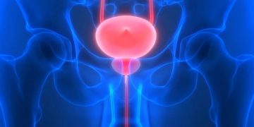 Cáncer de uretra