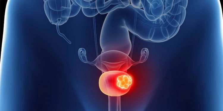 La conexión entre el colesterol y el cáncer de vejiga revela cómo niveles anormales pueden influir en el desarrollo y progresión de esta enfermedad