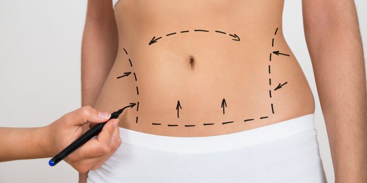 Lipoescultura: la técnica estética que redefine la silueta corporal