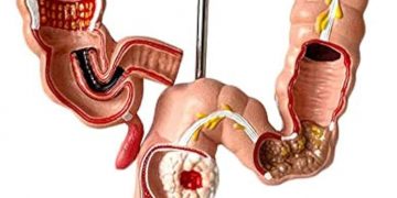 Prevención vital: Detección temprana sigue siendo clave contra el cáncer de colon