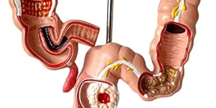 Prevención vital: Detección temprana sigue siendo clave contra el cáncer de colon