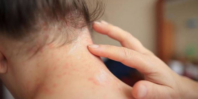 ¿Cuánto sabes sobre la dermatitis atópica?