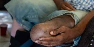 Alarma a dominicanos cada 30 segundos amputan una extremidad por diabetes en el mundo; El Bronx entre lugares USA con más casos