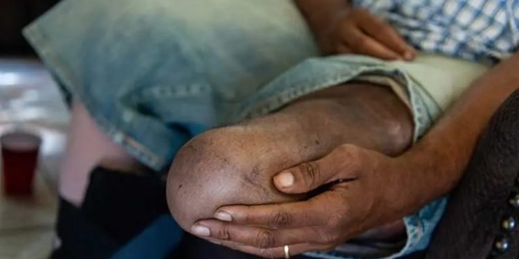 Alarma a dominicanos cada 30 segundos amputan una extremidad por diabetes en el mundo; El Bronx entre lugares USA con más casos