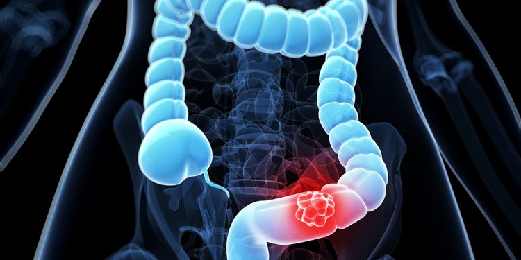 Avances en la detección del cáncer de colon mediante un simple análisis de sangre