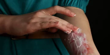 Esto es lo que no debes hacer si sufres una quemadura, según expertos