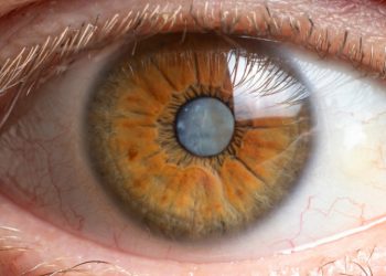 Operar cataratas en ambos ojos a la vez: una opción cada vez más segura