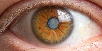 Operar cataratas en ambos ojos a la vez: una opción cada vez más segura