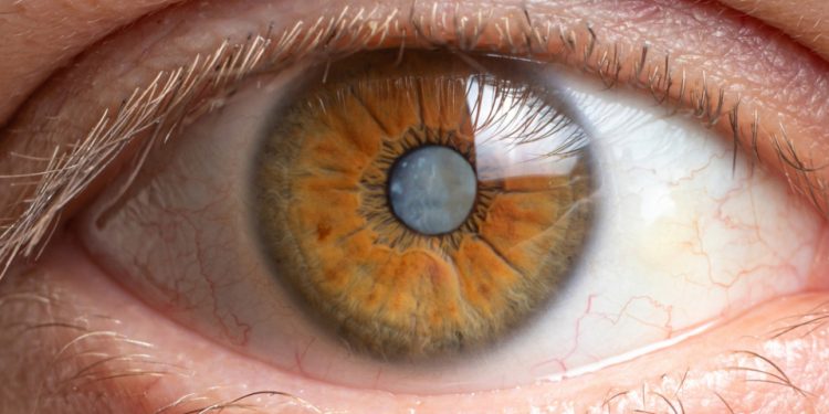 Operar cataratas en ambos ojos a la vez: una opción cada vez más segura