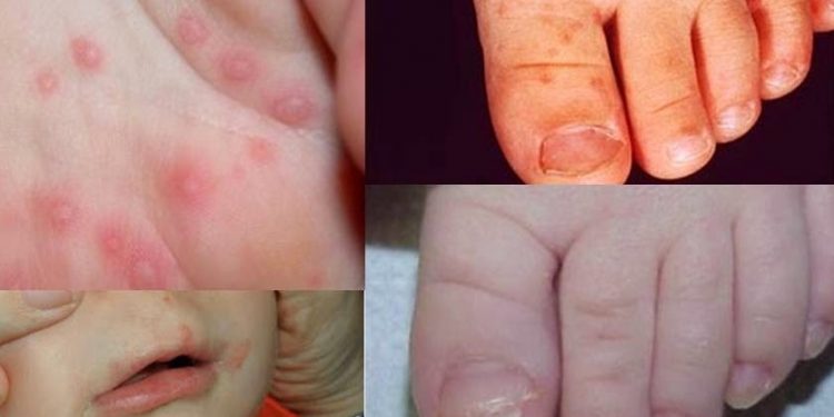 Especialistas advierten sobre el aumento de casos de la enfermedad mano-boca-pie en niños menores de cinco años