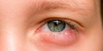 Alergia o infección en los ojos: cómo identificar la diferencia y cuándo acudir al especialista