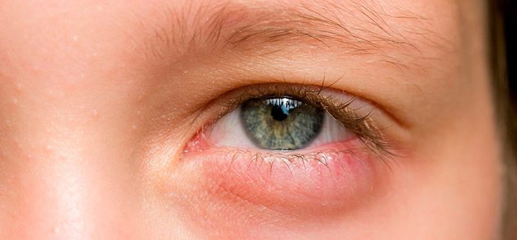 Alergia o infección en los ojos: cómo identificar la diferencia y cuándo acudir al especialista