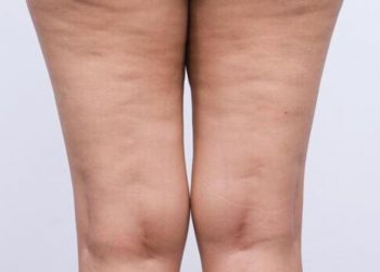 Lipedema: el problema de salud que afecta piernas, muslos y caderas y muchas veces se confunde con obesidad