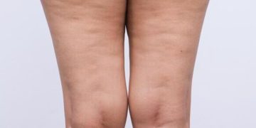 Lipedema: el problema de salud que afecta piernas, muslos y caderas y muchas veces se confunde con obesidad