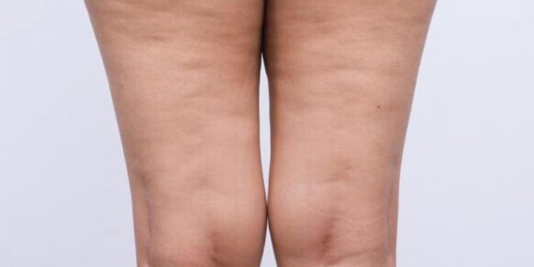 Lipedema: el problema de salud que afecta piernas, muslos y caderas y muchas veces se confunde con obesidad