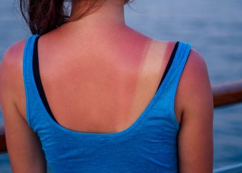 Dermatólogos advierten qué hacer —y qué evitar— ante una quemadura solar