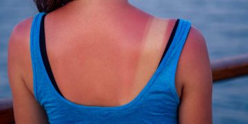 Dermatólogos advierten qué hacer —y qué evitar— ante una quemadura solar