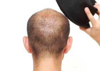 ¿La gorra provoca la caída del cabello?