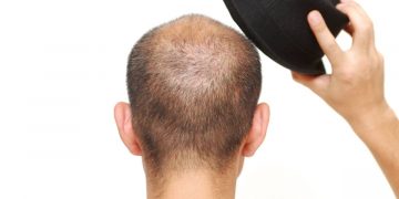 ¿La gorra provoca la caída del cabello?