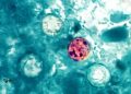 Parásito Ciclosporiasis: Aumentan casos de diarrea grave en NYC y otros estados; dominicanos en alerta