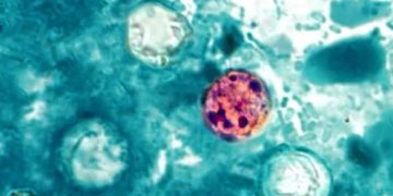 Parásito Ciclosporiasis: Aumentan casos de diarrea grave en NYC y otros estados; dominicanos en alerta