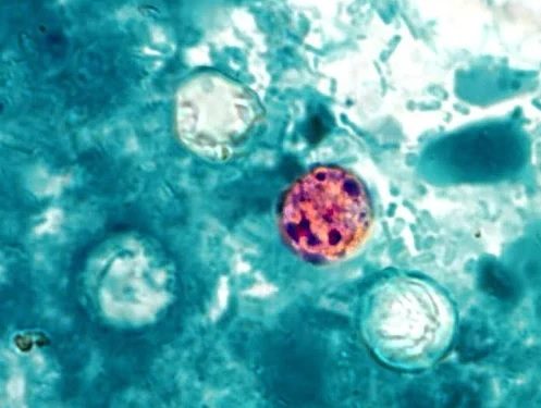 Parásito Ciclosporiasis: Aumentan casos de diarrea grave en NYC y otros estados; dominicanos en alerta