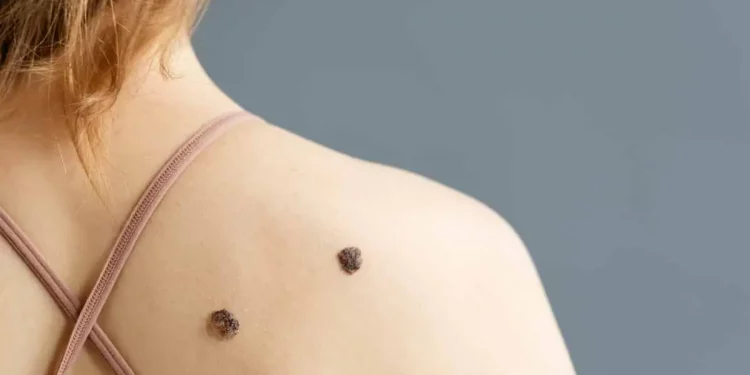 Melanoma metastásico: qué es, cuáles son sus síntomas y cómo se trata