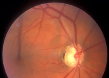 Estatinas podrían influir en la evolución del glaucoma