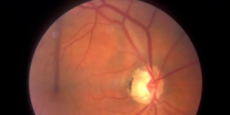 Estatinas podrían influir en la evolución del glaucoma